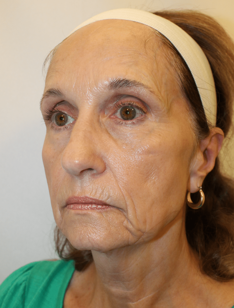 Before Image:  - left-front-oblique