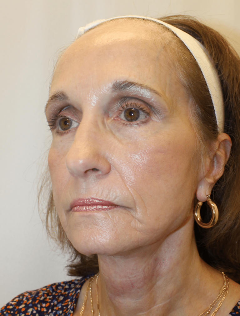 After Image:  - left-front-oblique