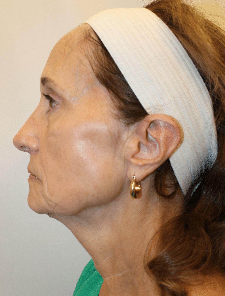 Before Image:  - left-side