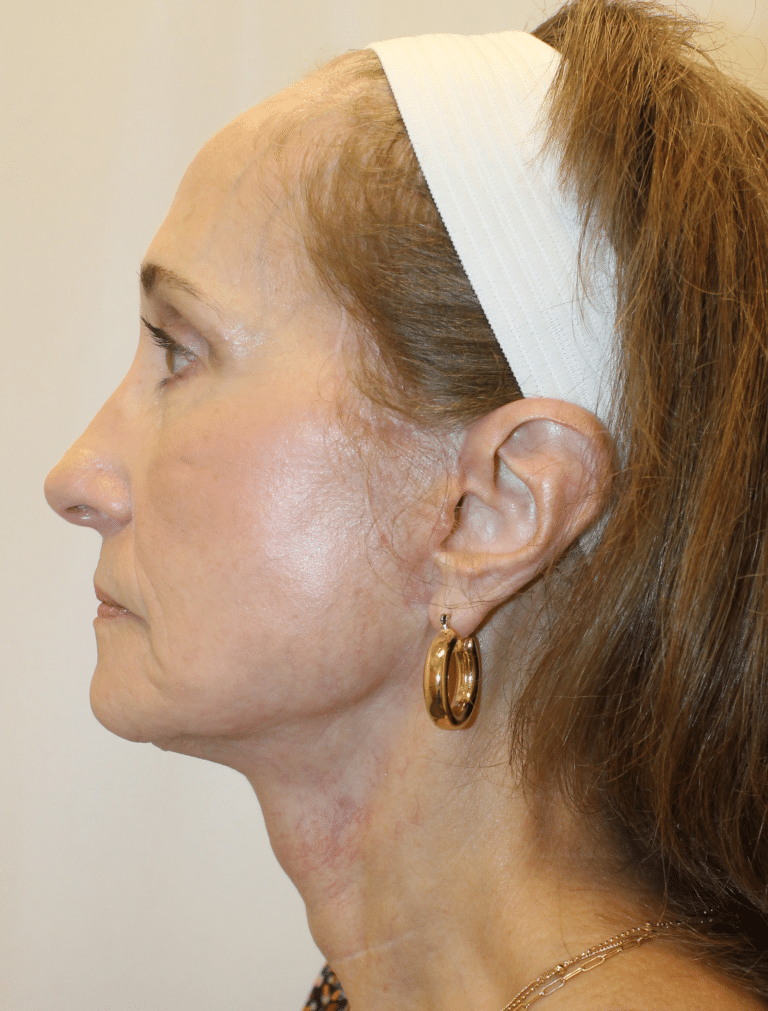 After Image:  - left-side