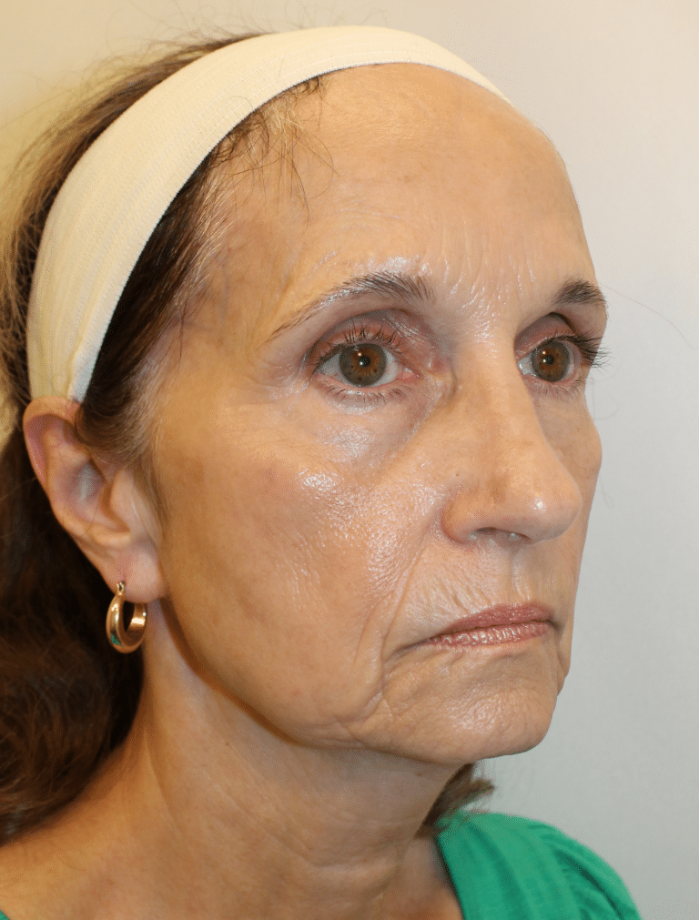 Before Image:  - right-front-oblique