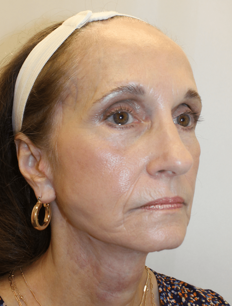 After Image:  - right-front-oblique