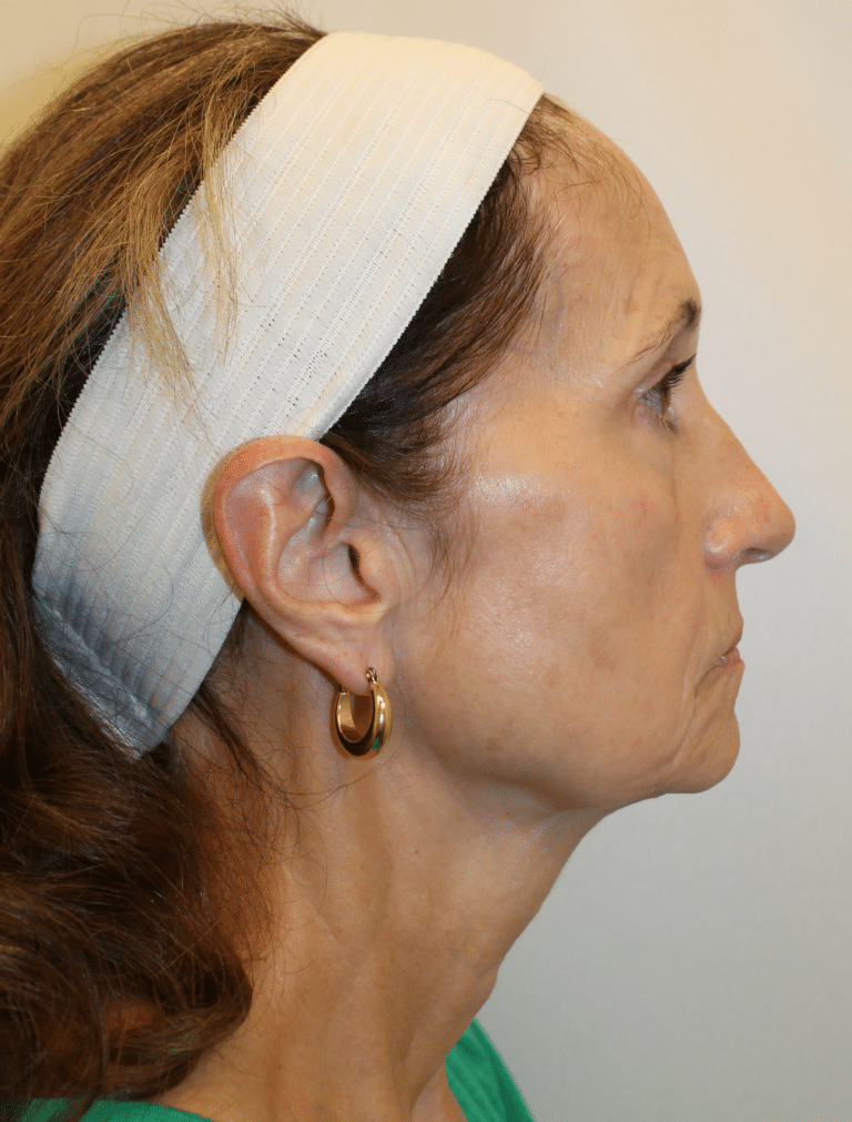 Before Image:  - right-side