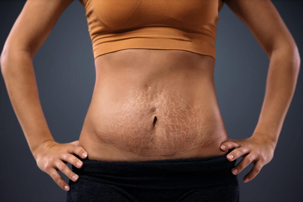 Close up of a woman's stomach with loose skin and stretch marks after childbirth, in need of a mommy makeover