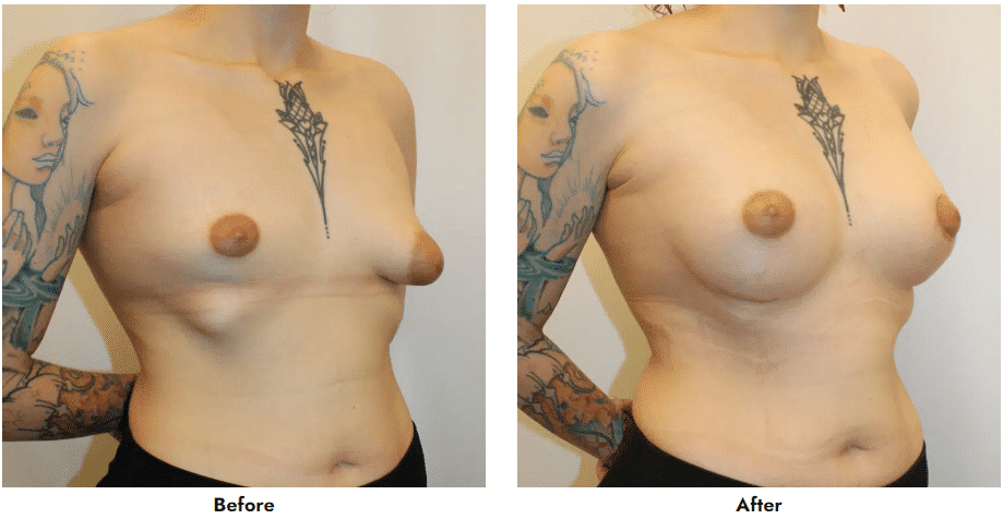 1766077242_Screenshot-2023-09-07-204644 Breast Asymmetry Correction in Gainesville, FL