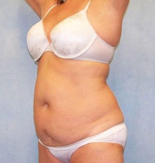 1766080121_0411023706-7of12 Tummy Tuck in Gainesville, FL