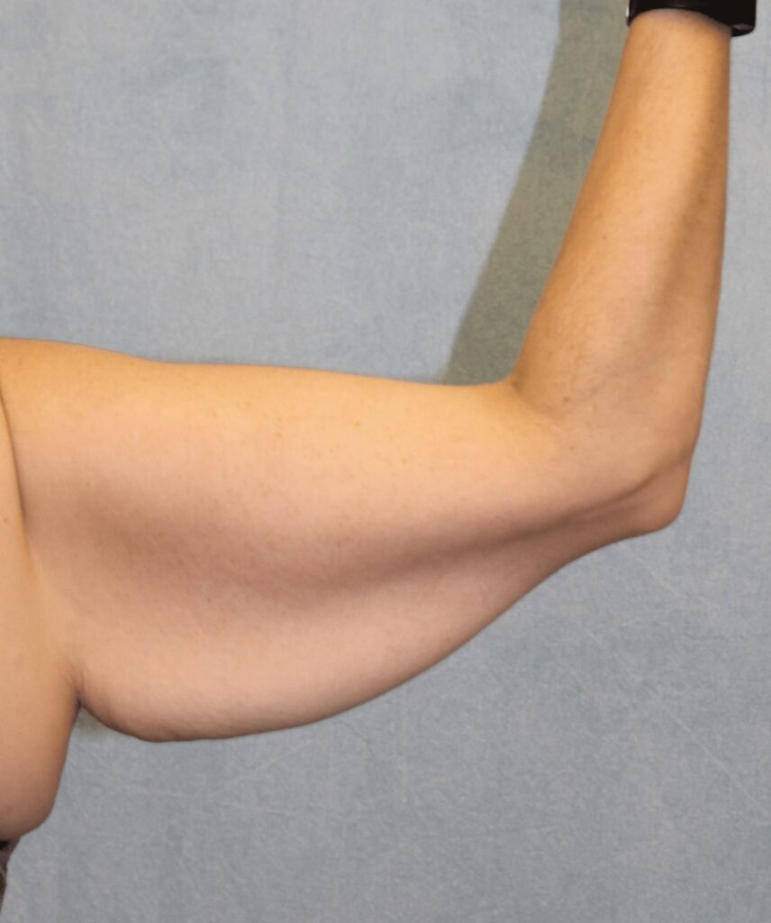 1766080138_1B-1 Brachioplasty in Gainesville, FL
