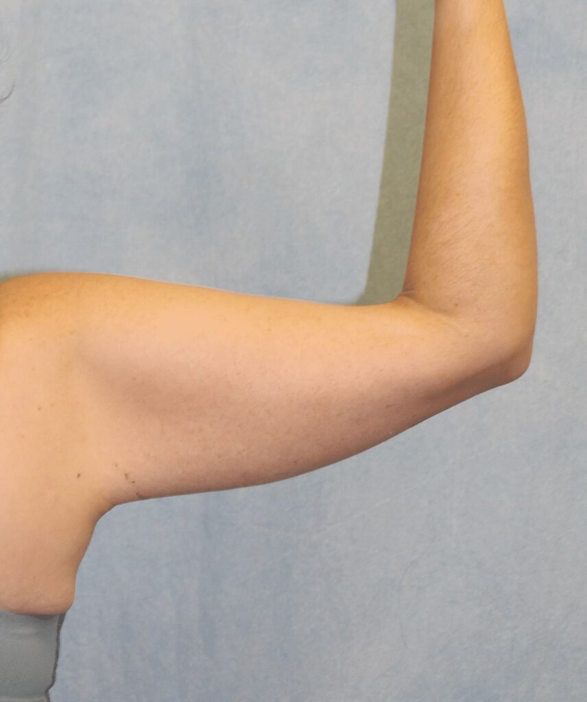 1766080148_4A-1 Brachioplasty in Gainesville, FL