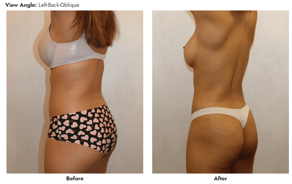Liposuction in Gainesville, FL