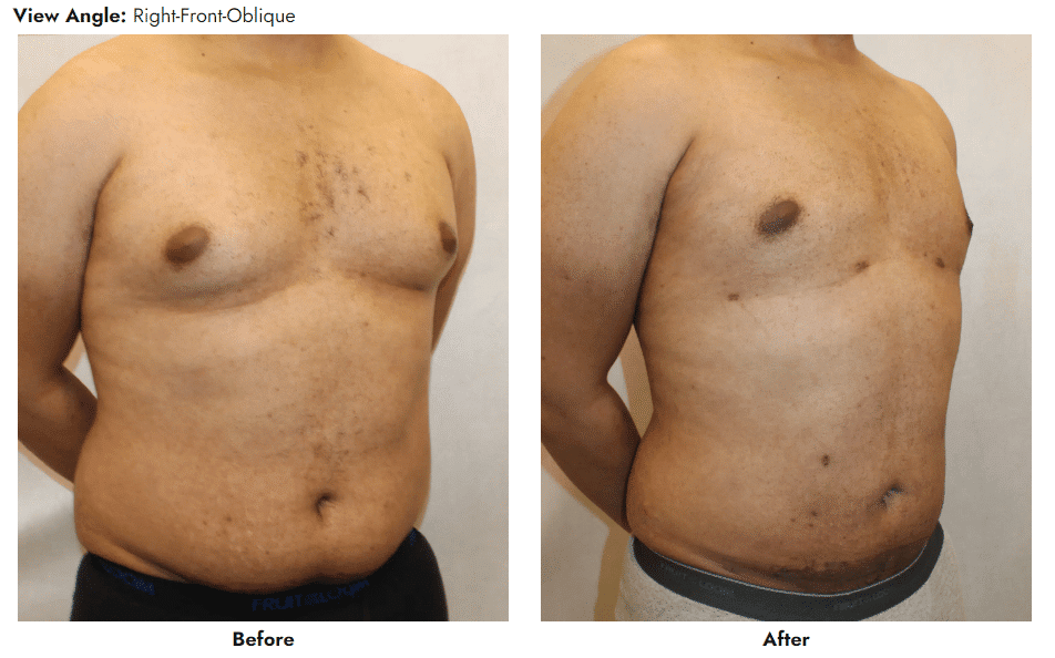 1766080198_image-3 Liposuction in Gainesville, FL