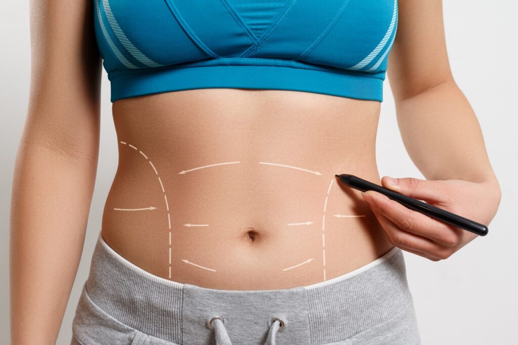 Reverse Tummy Tuck in Gainesville, FL