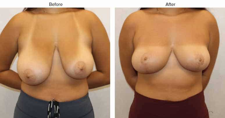 1766080326_Front-View Breast Reduction in Gainesville, FL
