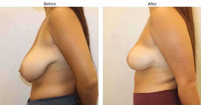 1766080329_Sideview-1 Breast Reduction in Gainesville, FL