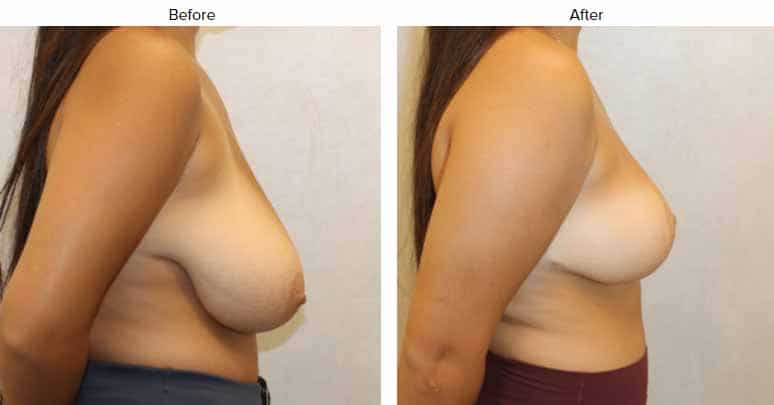 1766080332_Sideview-2 Breast Reduction in Gainesville, FL