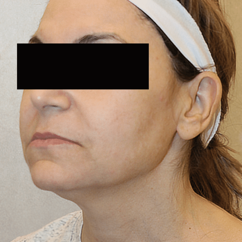 1766080363_3-4 Buccal Fat Removal in Gainesville, FL