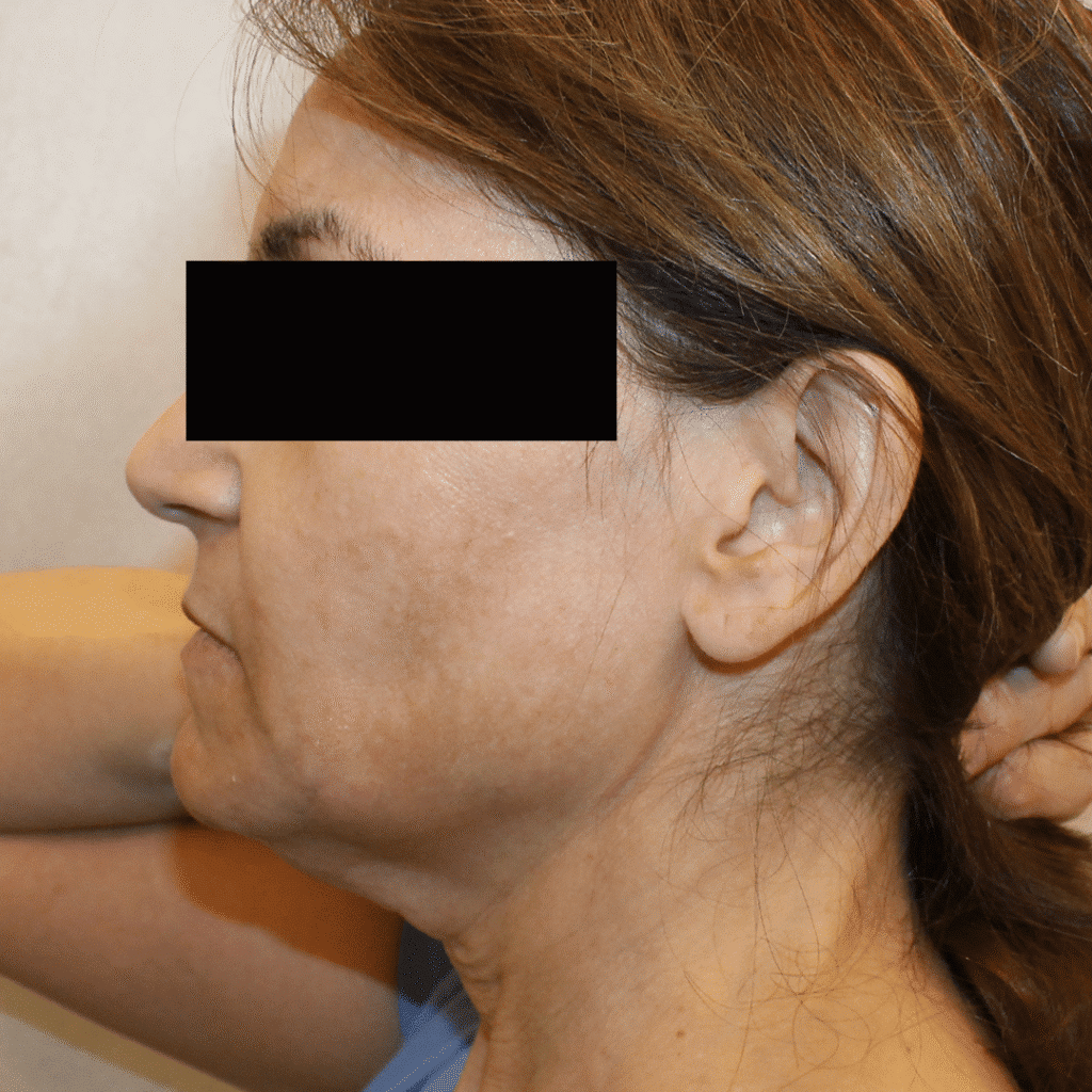1766080385_6-4 Buccal Fat Removal in Gainesville, FL