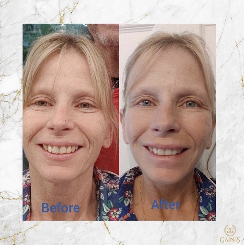 1766080404_IMG_7932 Facelift in Gainesville, FL