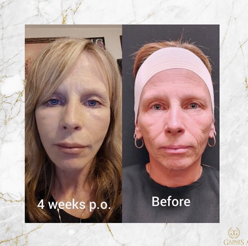 1766080407_IMG_7934 Facelift in Gainesville, FL