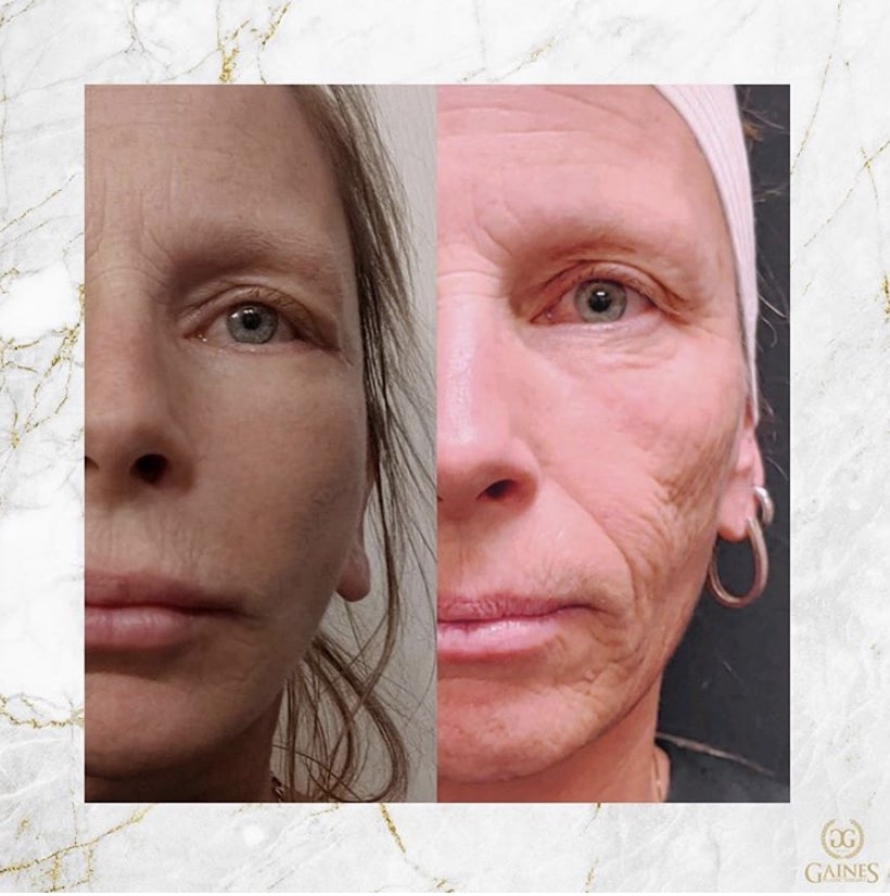 1766080411_IMG_7935 Facelift in Gainesville, FL