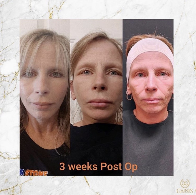 1766080418_IMG_7933 Facelift in Gainesville, FL