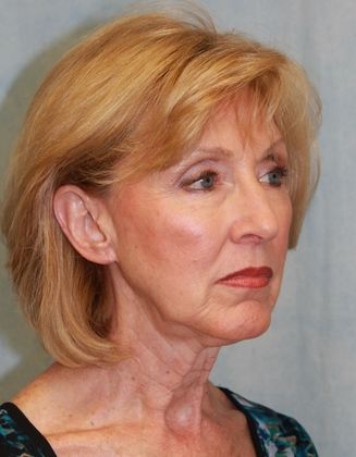 1766080421_Case-271-Facelift-b2 Facelift in Gainesville, FL