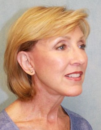 1766080424_Case-271-Facelift-a2 Facelift in Gainesville, FL