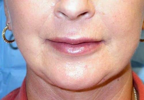 1766080447_original-1462306661 Fat Grafting in Gainesville, FL