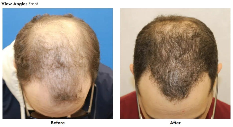 1766080481_case-3033-top-view Hair Transplant In Gainesville, FL