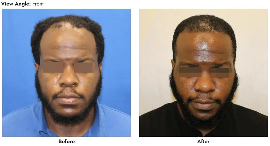 1766080486_case-3016-front-view Hair Transplant In Gainesville, FL