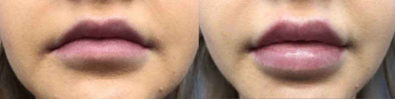 1766080538_before-photo-2 Lip Fillers in Gainesville, FL