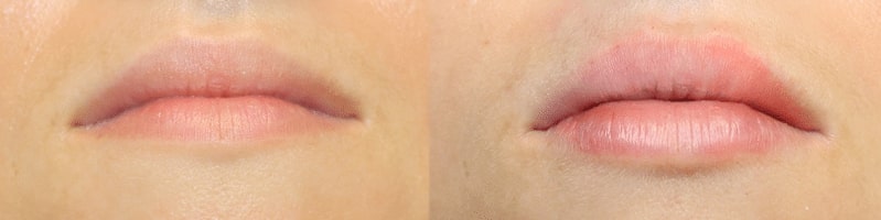 1766080541_Site-lip-filler2 Lip Fillers in Gainesville, FL