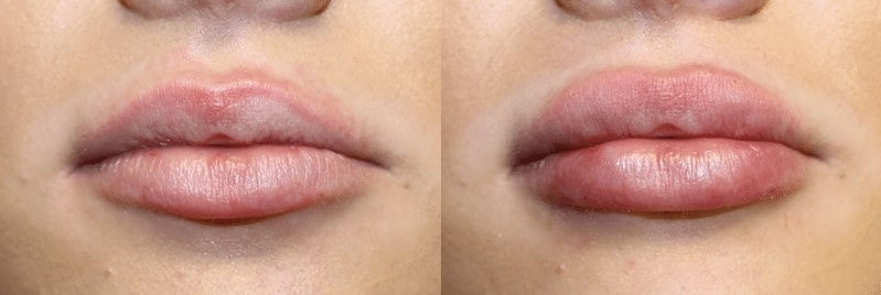 1766080543_Sie-lip-filler Lip Fillers in Gainesville, FL