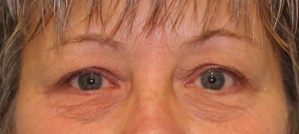 1766080710_Case-538-Eye-Lift-Blepharoplasty-b1 Blepharoplasty in Gainesville, FL