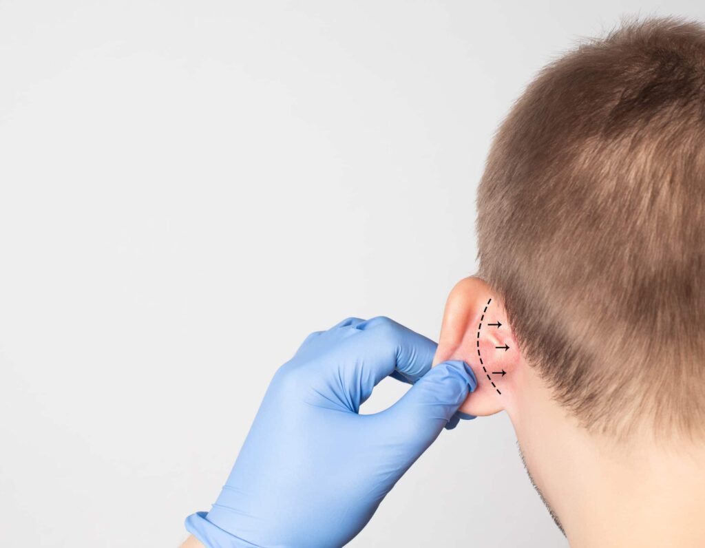 Otoplasty in Gainesville, FL