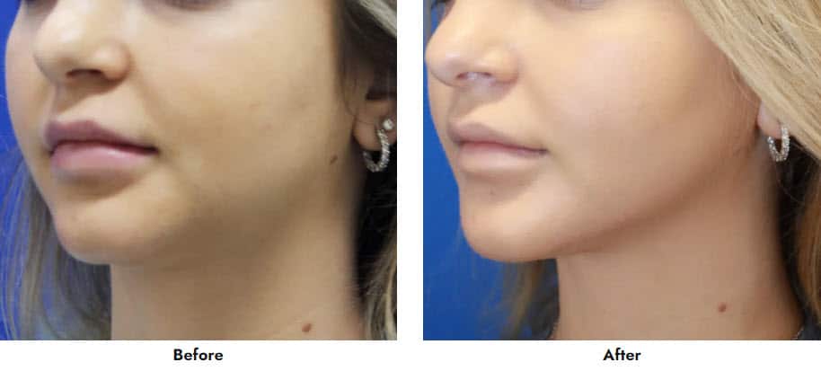 Jaw-Filler Juvederm in Gainesville, FL