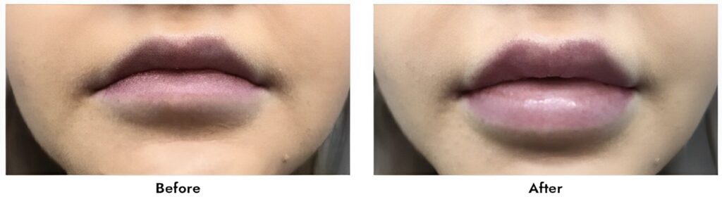 Lip-fillers-1 Juvederm in Gainesville, FL