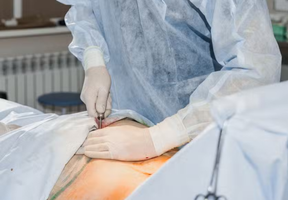 reverse tummy tuck performed Reverse Tummy Tuck in Gainesville, FL